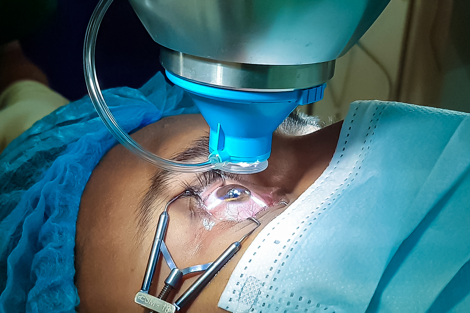 How Much Lasik Cost in Bangladesh | Is It Woíth It?